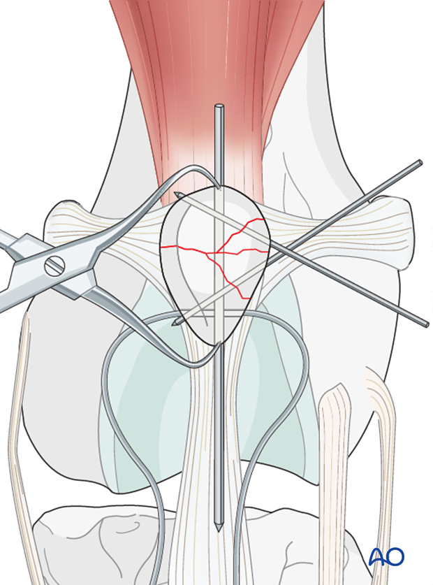 Single K-wire in small animal patella