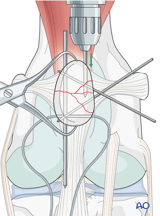 K-wires insertion