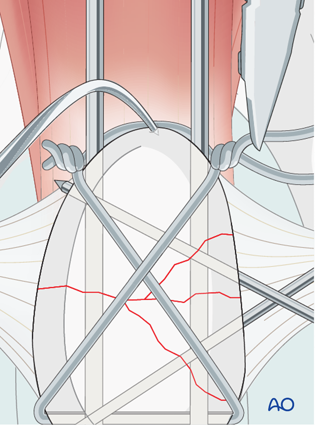 The excess length of the twist is trimmed
