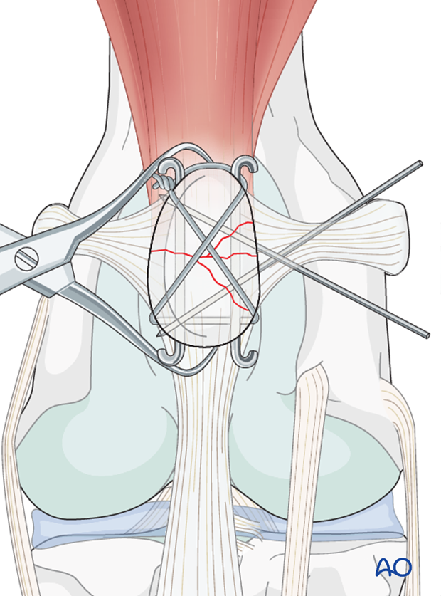 Single orthopedic wire as tension band