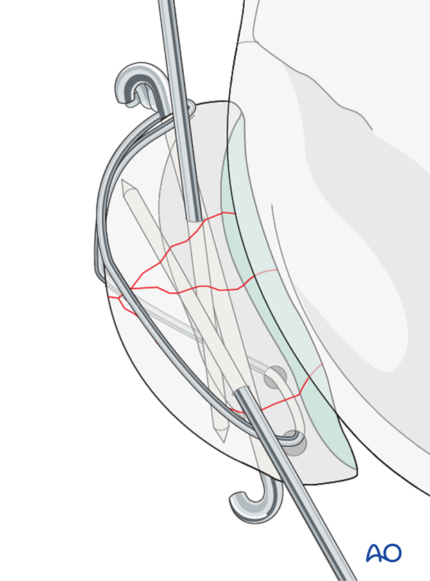 Articular surface evaluation