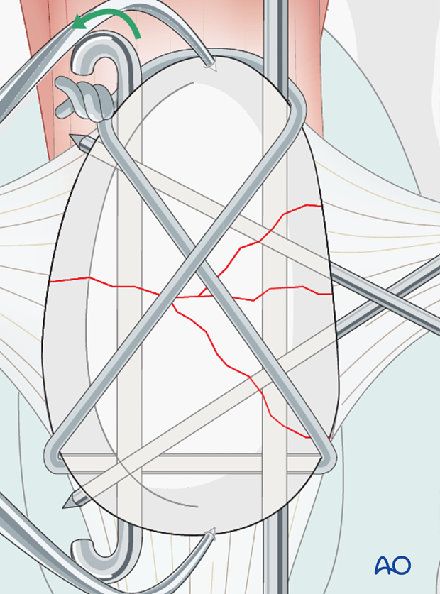 K-wires are cut and bent on the near end
