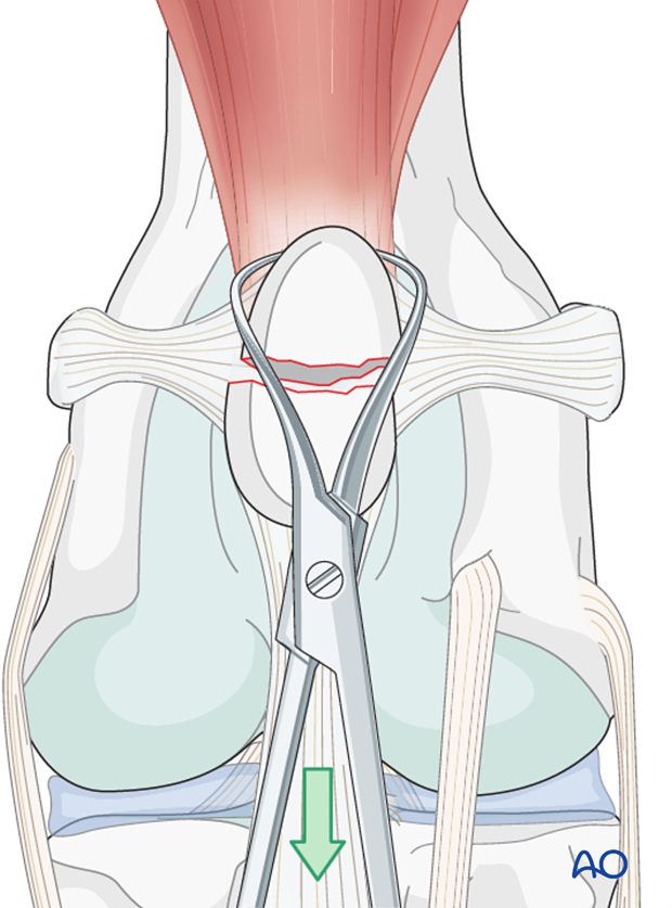 Reduction of patella fragments
