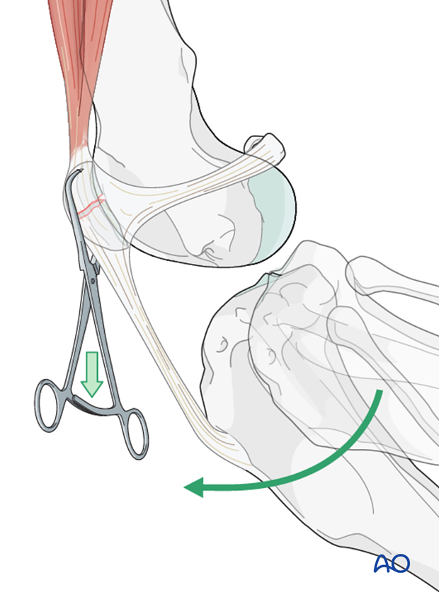 Stifle extension and reduction