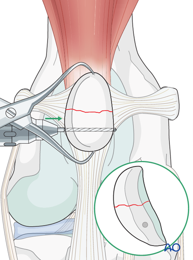 A hole is drilled transversally in the extra-articular portion of the patella