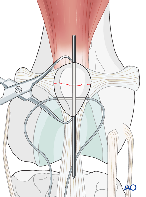 Single K-wire in small animal patella