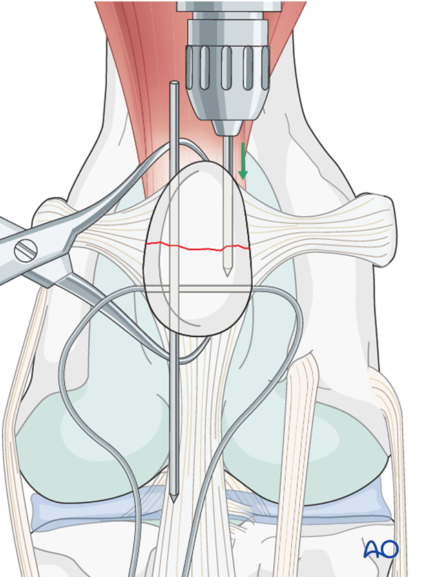 K-wires insertion