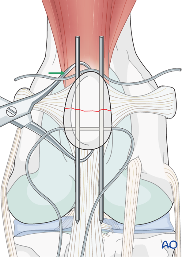 Second orthopedic wire insertion