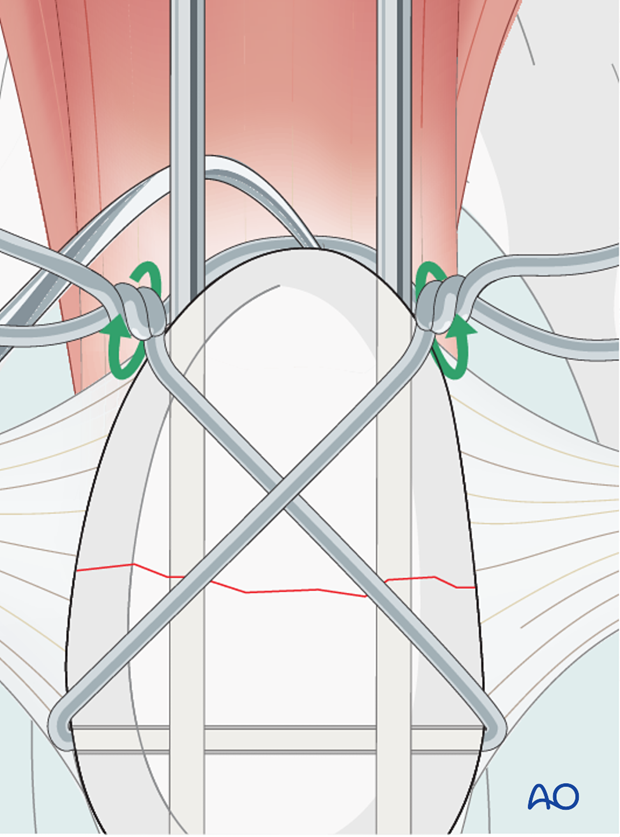 Image link Alt placeholder