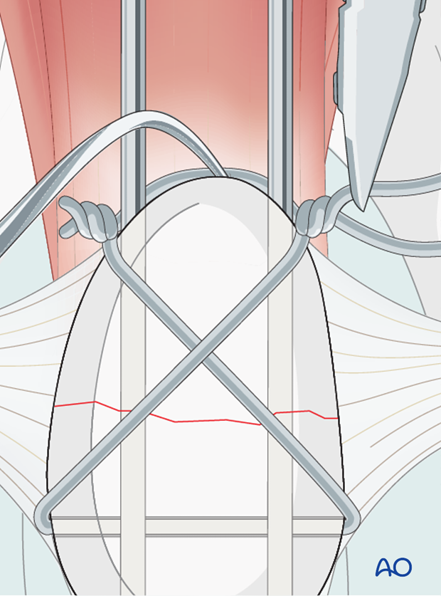 The excess length of the twist is trimmed