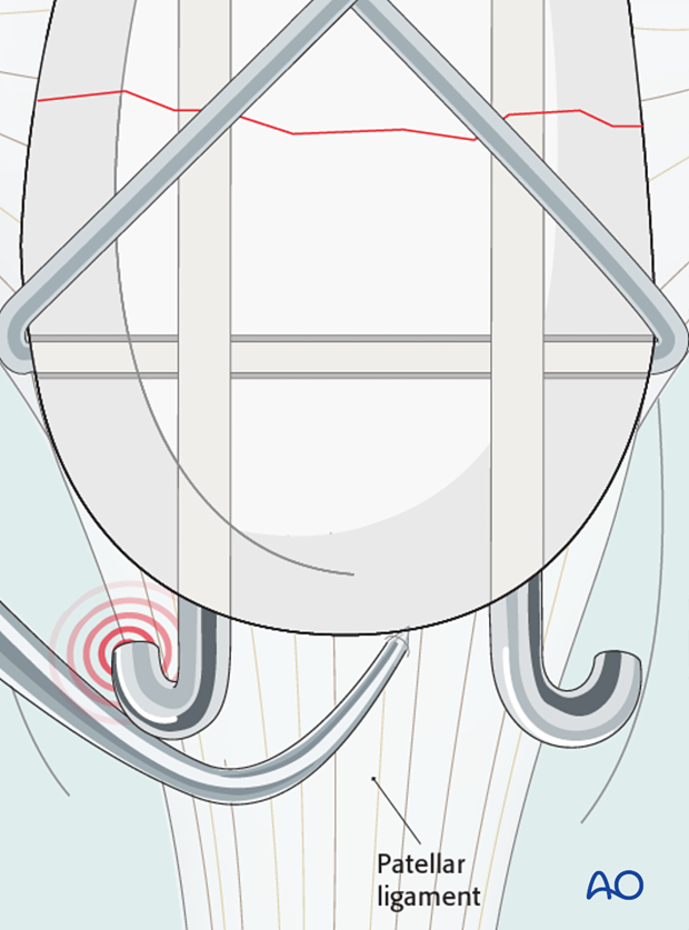 Risk of interference of the K-wires