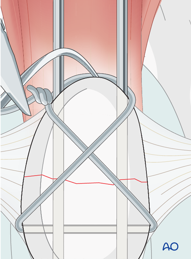The excess length of the twist is trimmed.