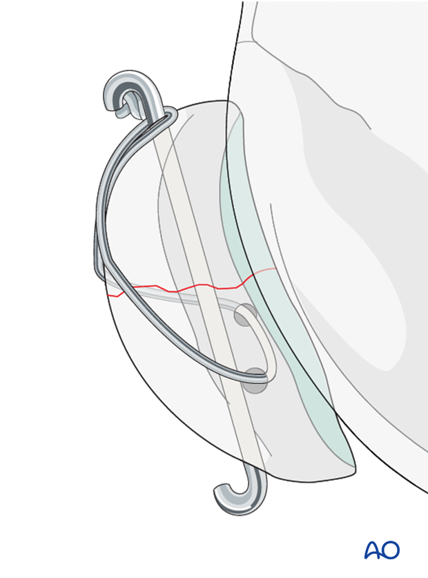 Articular surface evaluation