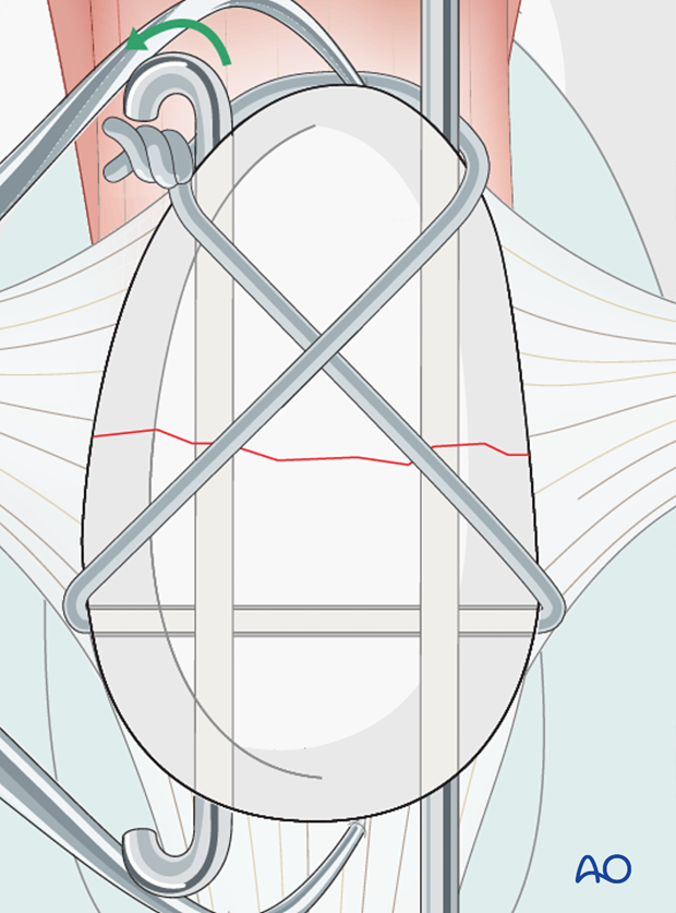 K-wires are cut and bent on the near end