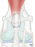 Lag screws fixation of the patella