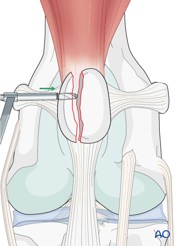 The hole is drilled away from the other fracture lines