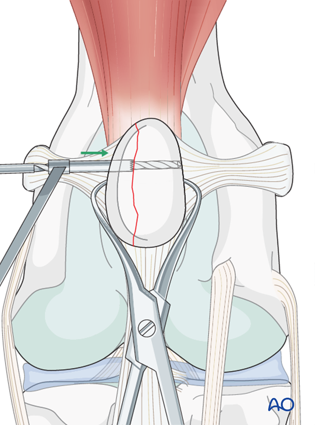A thread hole is drilled along the remainder of the patella