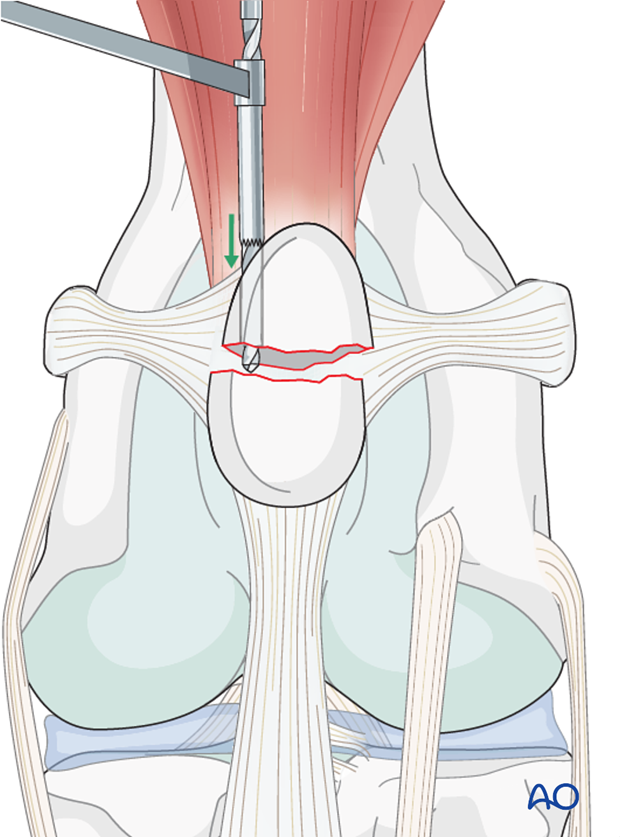 The hole is drilled away from the other fracture lines