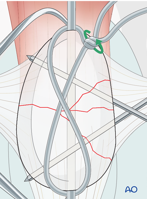 Orthopedic wire is wrapped in a figure of 8 pattern