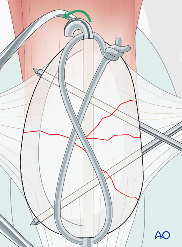 K-wires ends are cut and bent