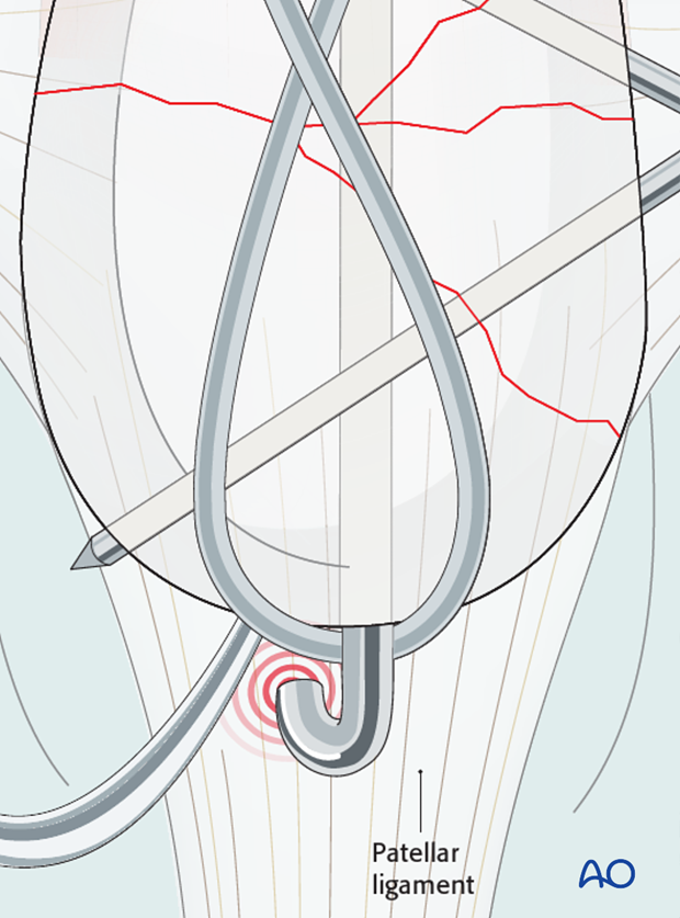 The end of the K-wires should not interfere with the patellar ligament