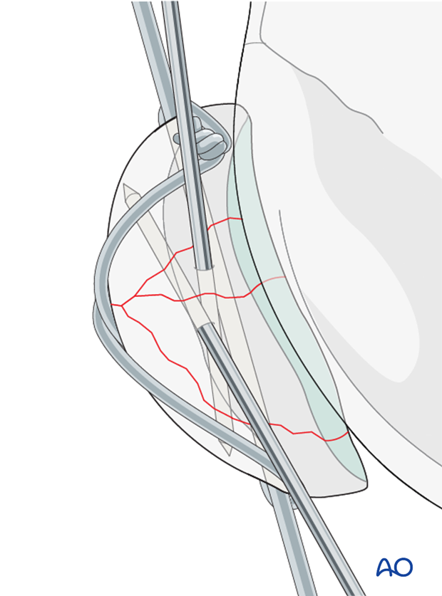 Articular surface evaluation
