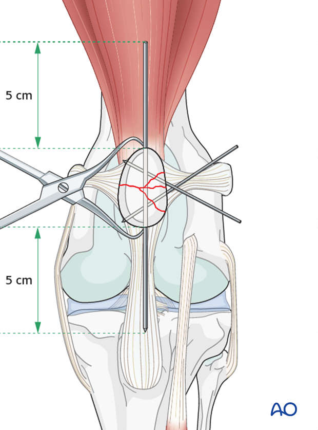 Both ends of the K-wire should be accessible