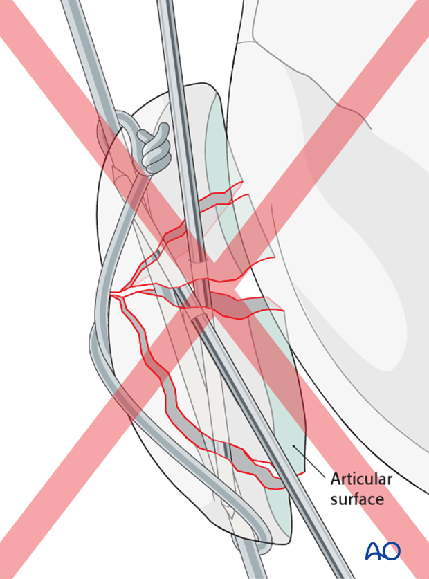 The K-wire is directed perpendicular to the main fracture line