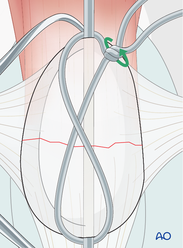 Orthopedic wire is wrapped in a figure of 8 pattern