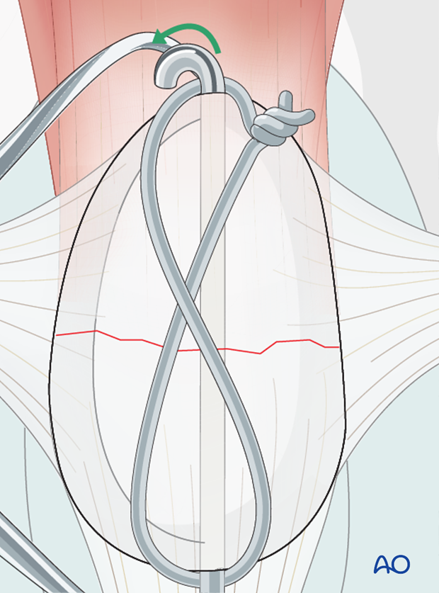 K-wires ends are cut and bent