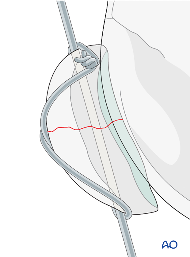 Articular surface evaluation