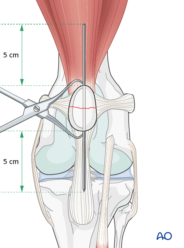 Both ends of the K-wire should be accessible