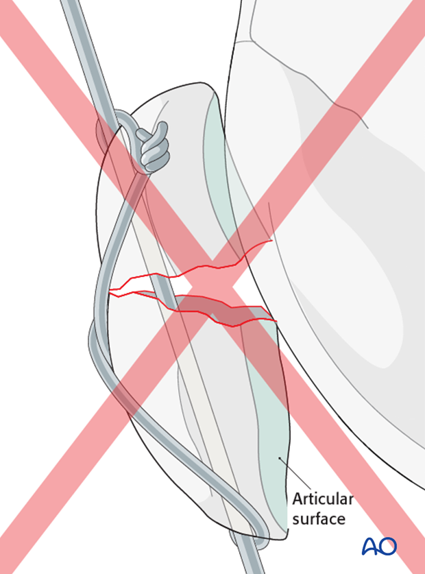 The K-wire is directed perpendicular to the main fracture line