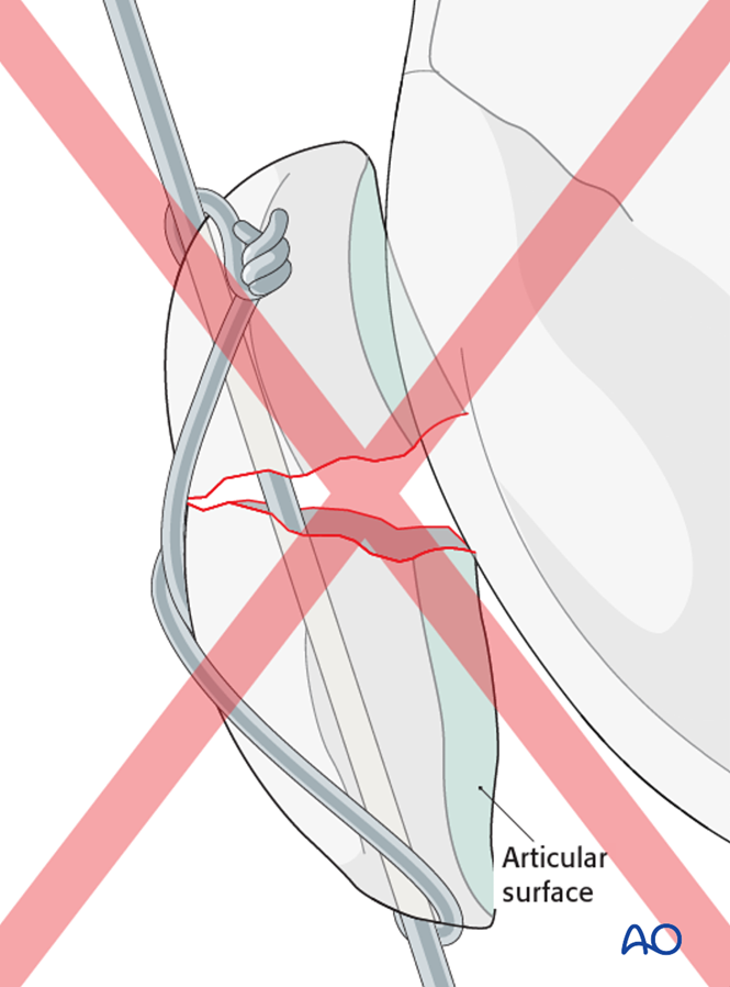 Figure Of 8 Technique Figure Of 8 Technique