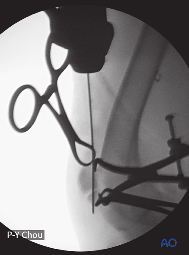 Intraoperative fluoroscopic image showing the patellar fragments after reduction