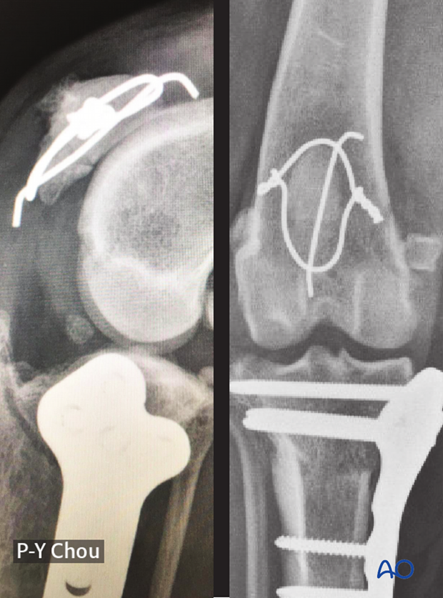 16 weeks follow-up after patellar fracture repair in a dog