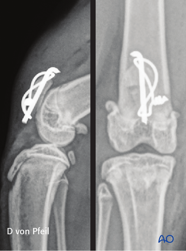 Postoperative x-ray of a patellar fracture in a skeletally immature cat repaired with skewer wire technique