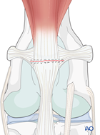 Total patellectomy