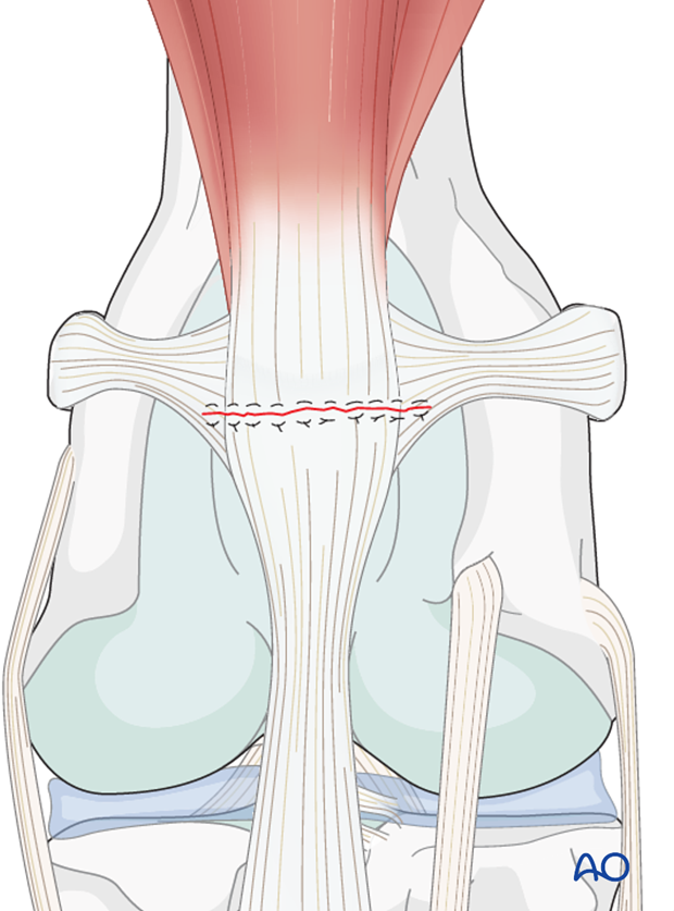 Total patellectomy