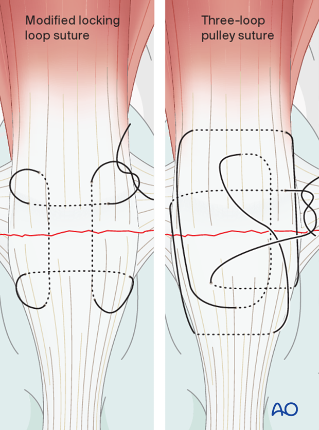 Suturing technique