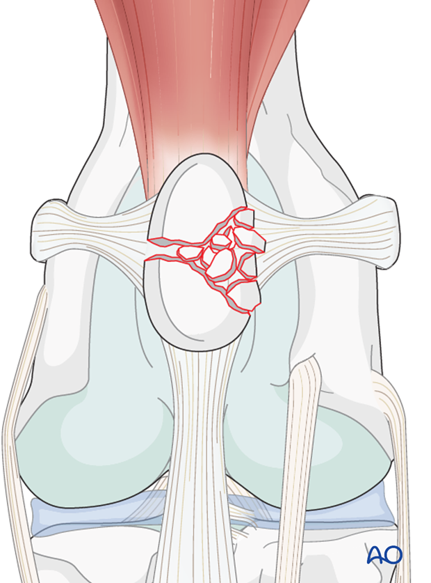Comminuted non-reconstructible patella