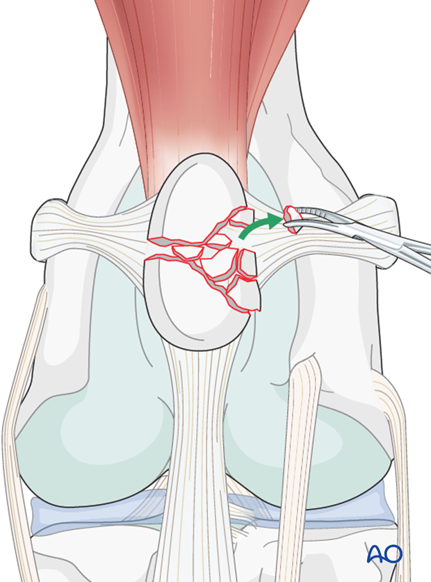 Non-reconstructible fragments are excised and removed