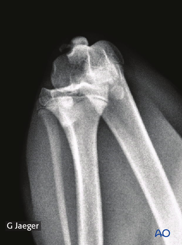 Tangential ("skyline") radiograph of a comminuted patellar fracture in a dog