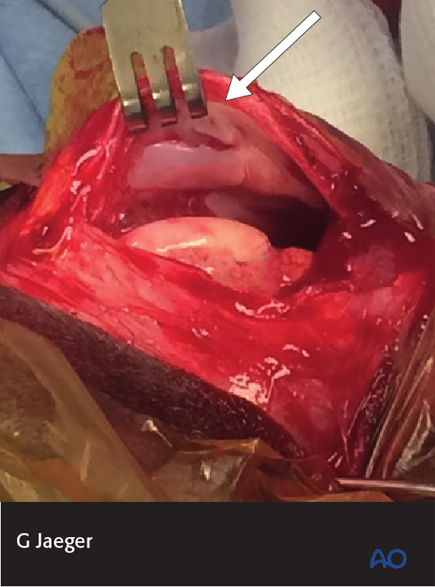 Lateral parapatellar approach