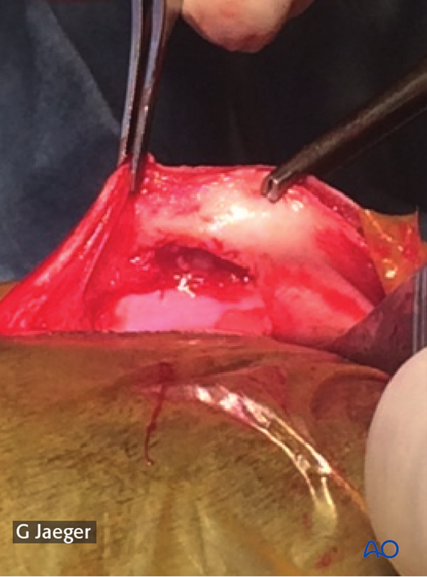 Patella after comminuted fragments removal