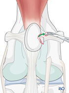 Patellar fragment excision