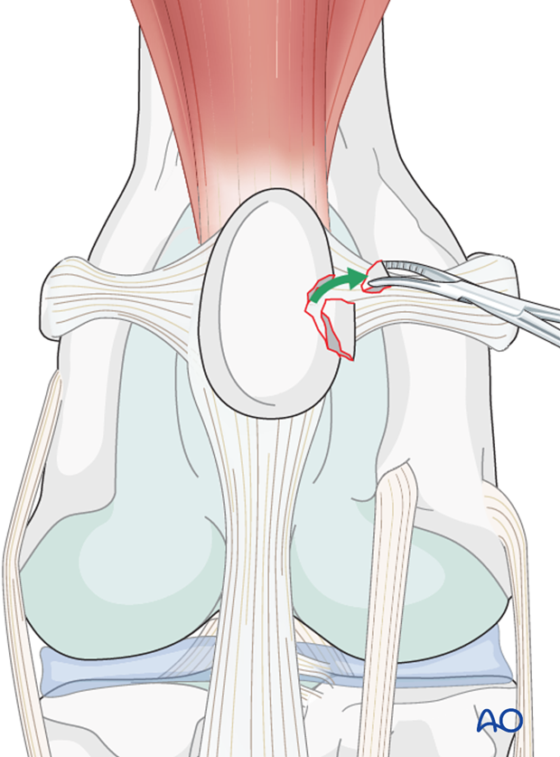 Patellar fragment excision