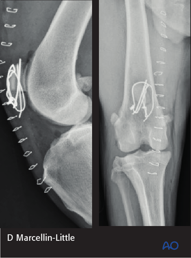 The fracture was repaired with 2 K-wires and two cerclages