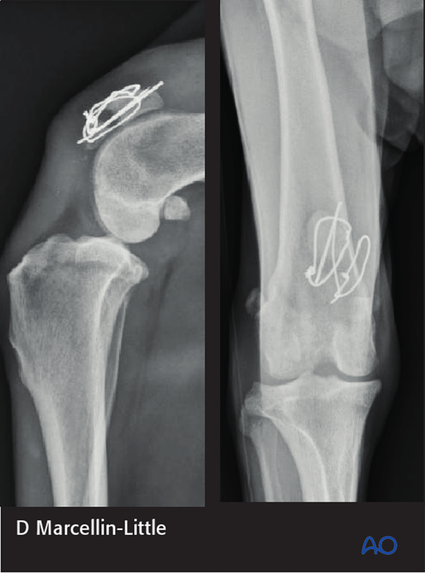 2-month postop radiographs show partial failure and nonunion