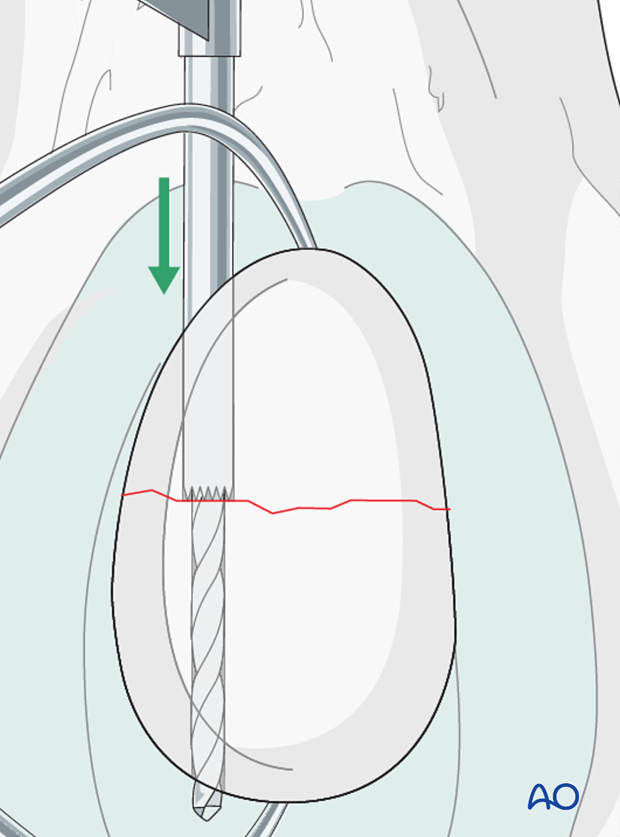 Hole drilling
